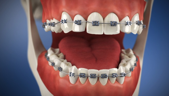 adult braces