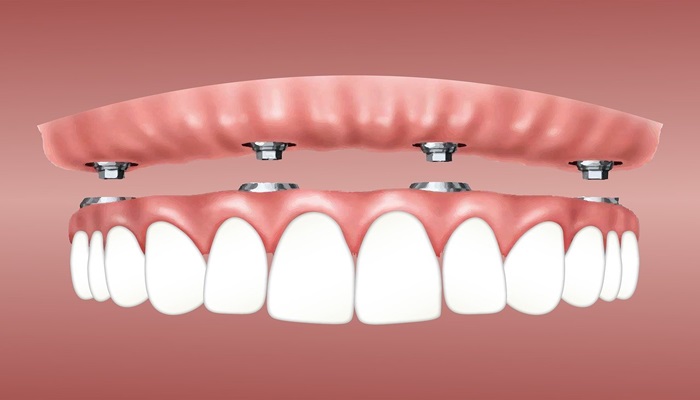 are dental implants covered by insurance