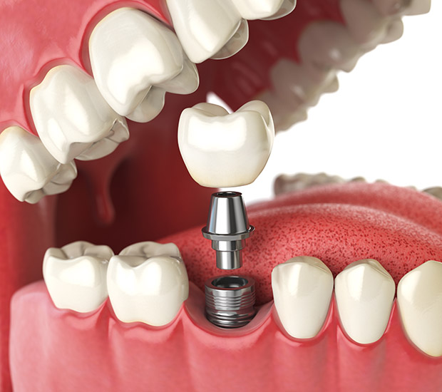 bone-graft-for-dental-implants