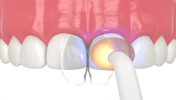 Composite Bonding