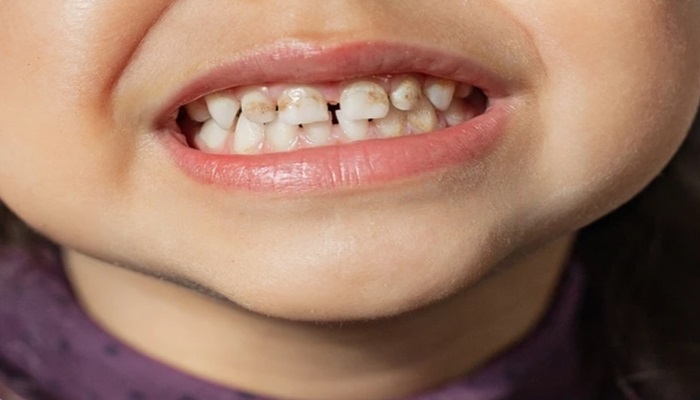 Dark spots on teeth that aren't cavities