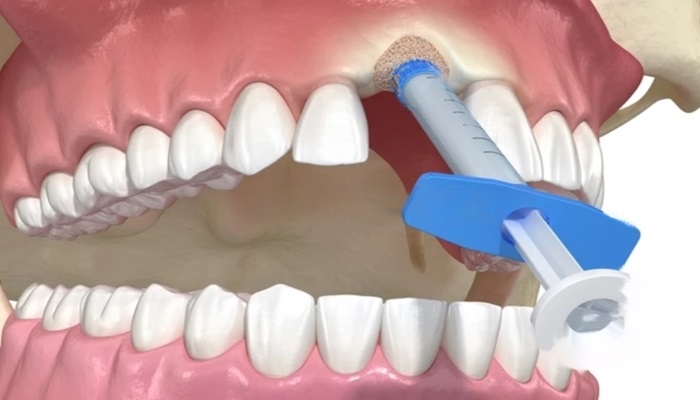 dental bone graft healing stages