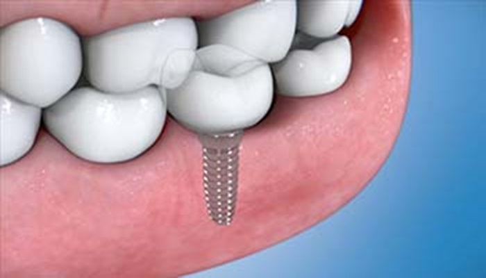 Dental Implants