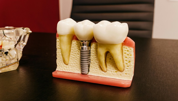 Dental Implants Near Me