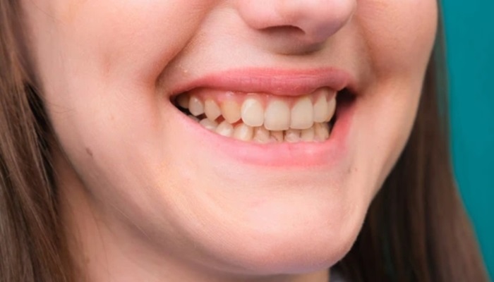 fluorosis teeth