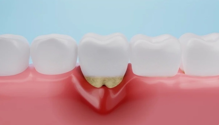 Gum Recession for periodontal