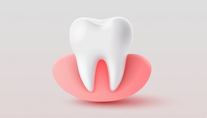 Gums growing overteeth