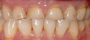 porcelain-crowns-3 before