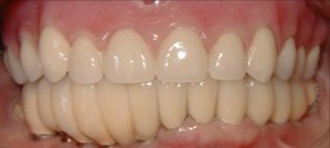 porcelain-crowns-9 before