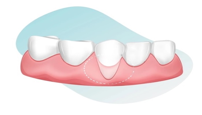 receding gums stages