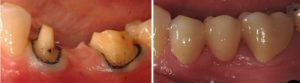 tooth crown before and after